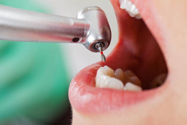 Best Emergency Dental Care for Abscessed Tooth in Canton, NC